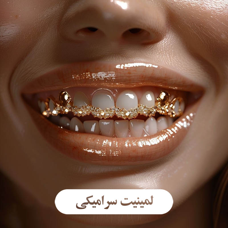 لمینیت سرامیکی
