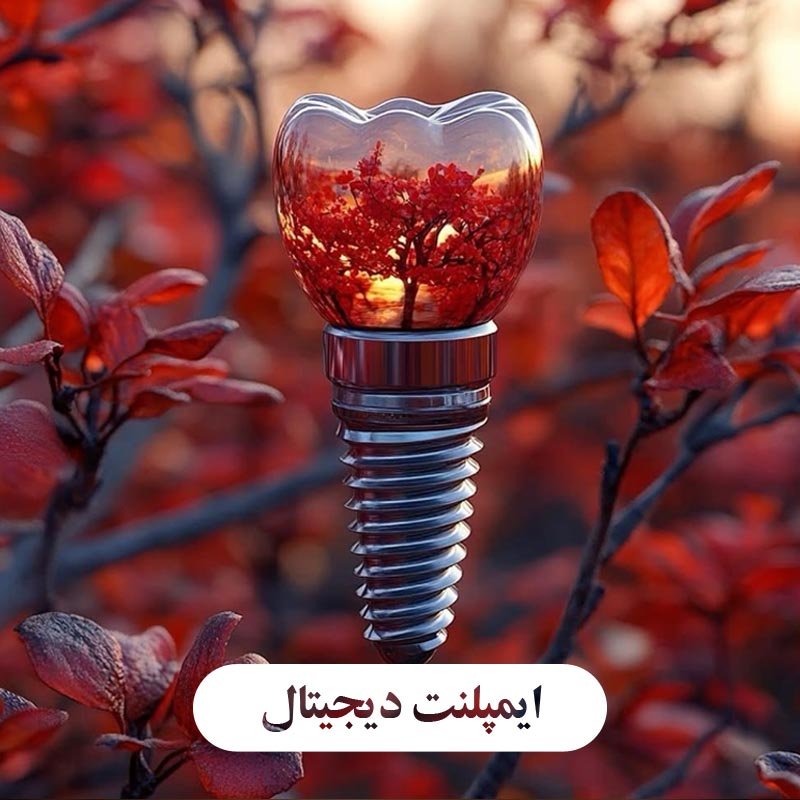 ایمپلنت دیجیتال