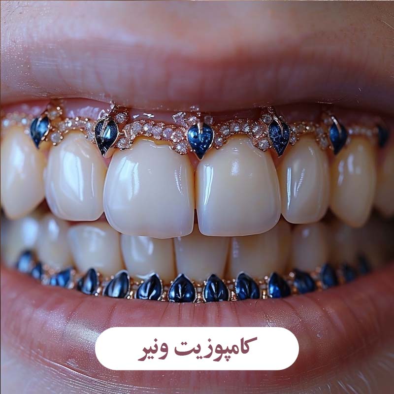 کامپوزیت ونیر
